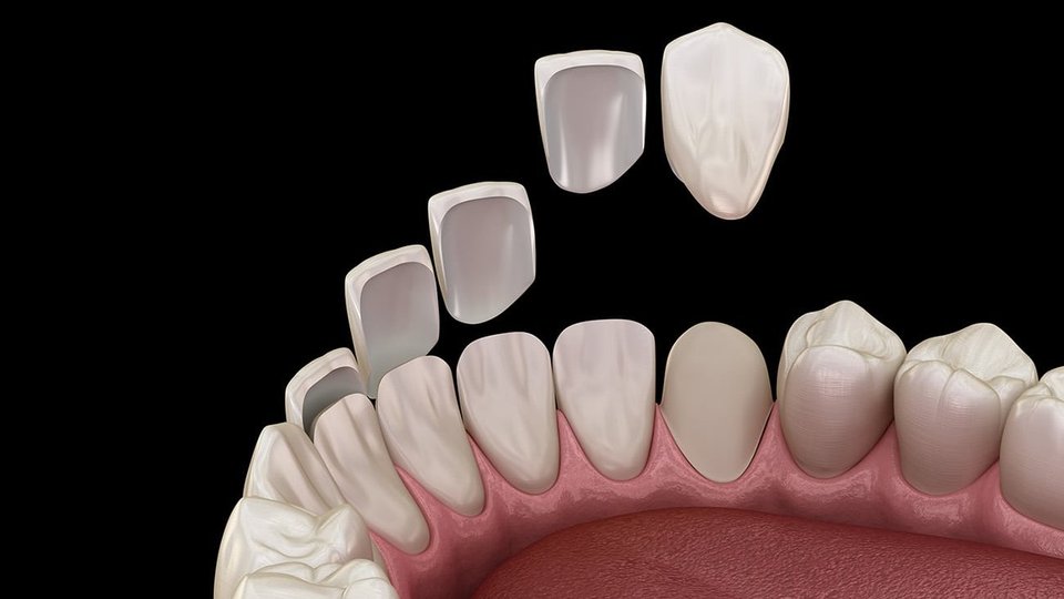 Veneers Köln Behandlung